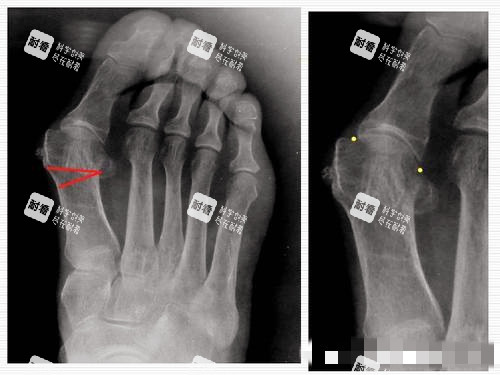 大脚骨X光片图片