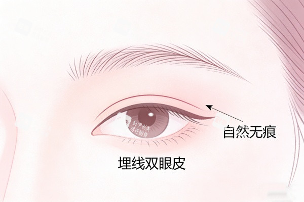 埋线双眼皮卡通图一览