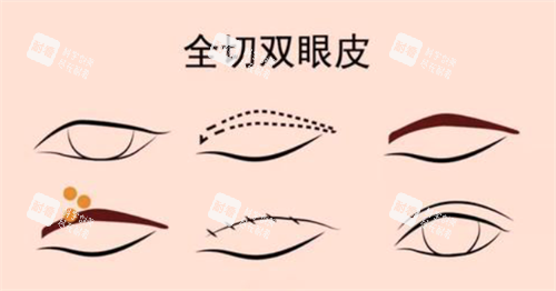 全切双眼皮经过