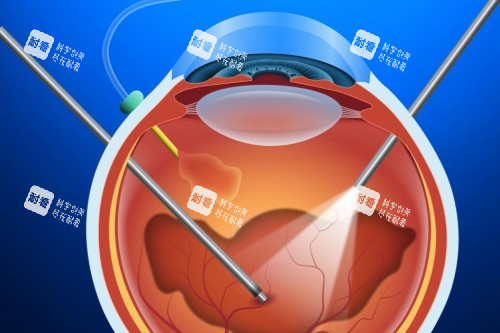 玻璃体切除术