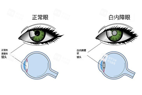 患白内障前后成像对比图
