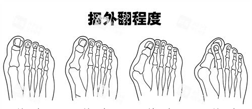 大脚骨外翻程度
