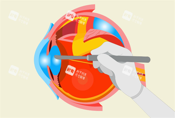 白内障卡通图