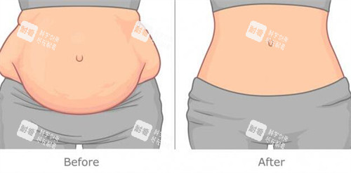 腹壁整形改善对比卡通图