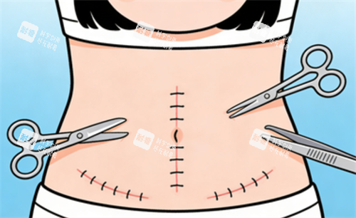 腹壁成形的手术位置