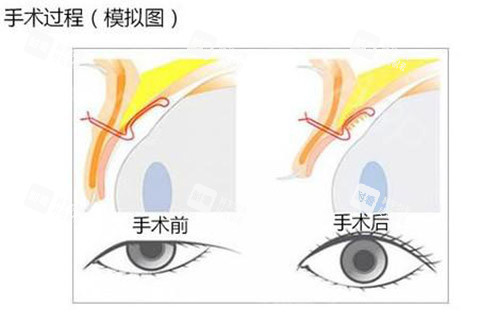 眼提肌手术照片