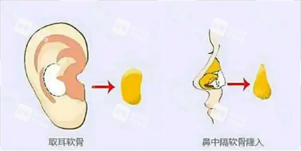 耳软骨隆鼻