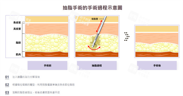 吸脂手术过程示意