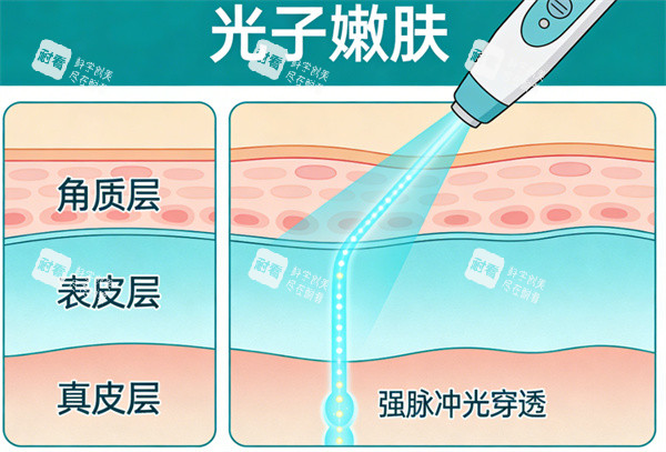 光子嫩肤操作卡通示意图