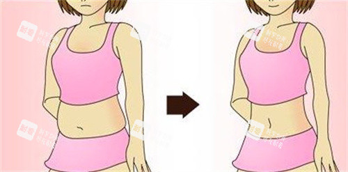 吸脂瘦身前后对比