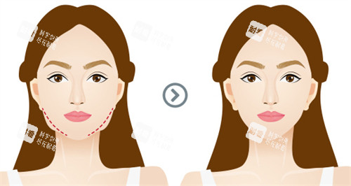 面部提升前后对比