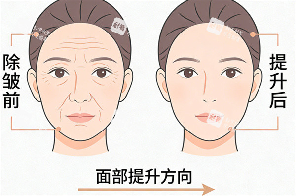 面部提升除皱前后对比