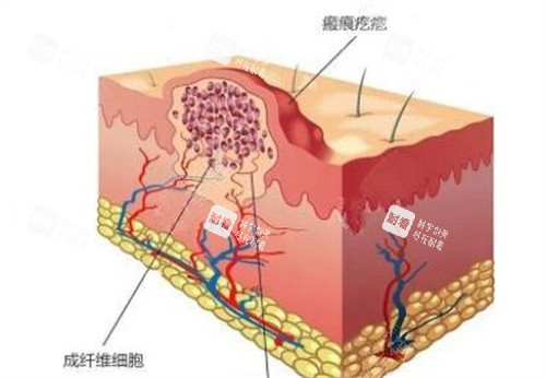 疤痕疙瘩怎么形成的