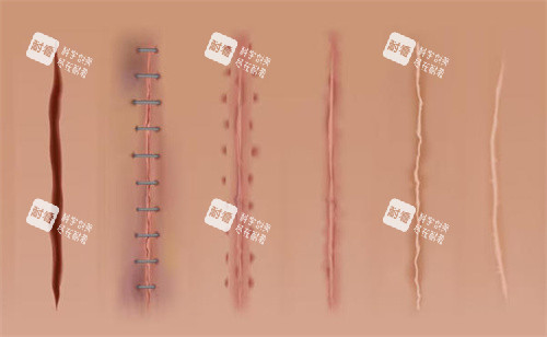 疤痕缝合修复过程