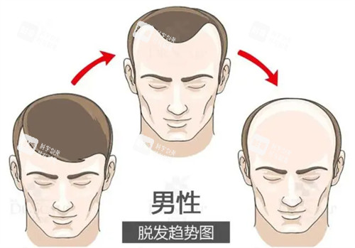 脱发趋势图