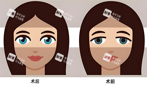 双眼皮术后术前对比动画图