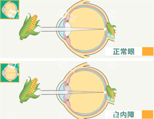 屈光性白内障