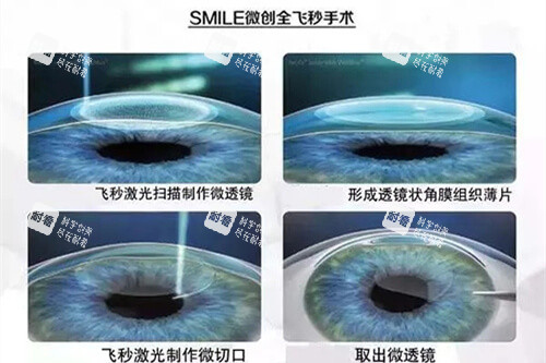 微创全飞秒手术过程示意图