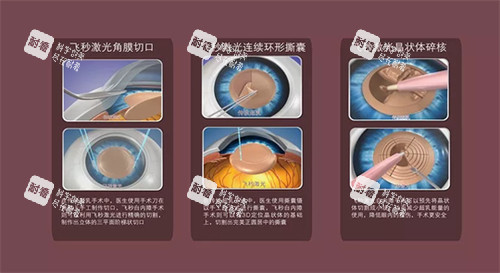 飞秒白内障手术流程