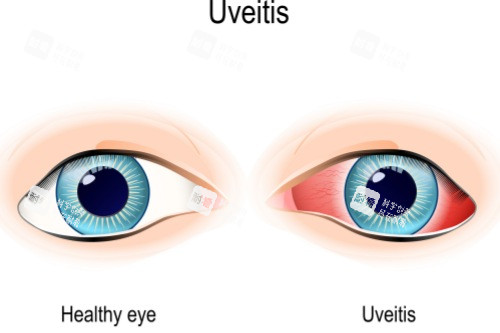葡萄膜炎 (7)