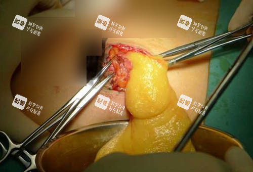 奥美定取出手术细节图