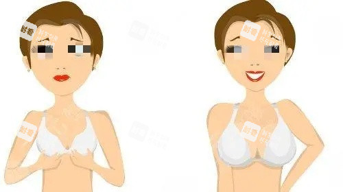 假体隆胸术后示意图