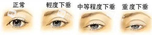 上睑下垂分级.webp