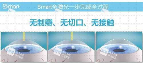 全激光优势