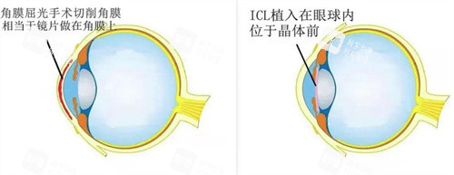 ICL植入和屈光手术