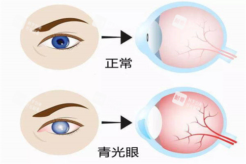 正常的眼睛与青光眼对比素材
