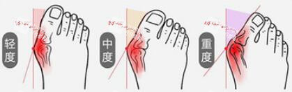 拇外翻大脚骨程度