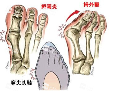 脚趾拇外翻卡通图照片