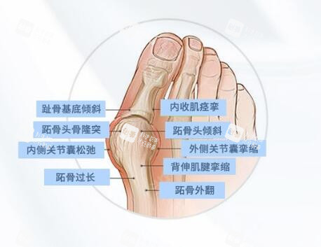 拇外翻原因分享
