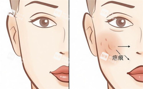 祛疤前后对比卡通图