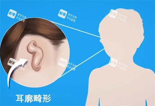 耳廓畸形