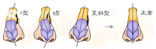歪鼻矫正类型