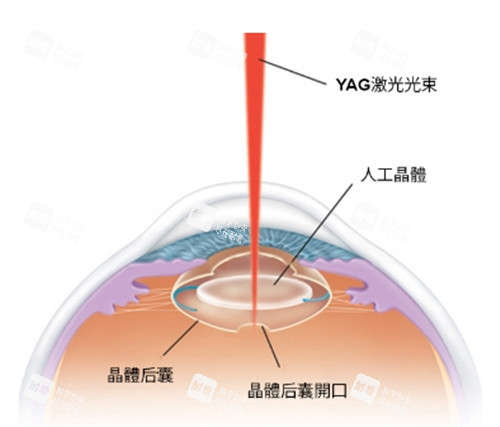 激光治疗细节图