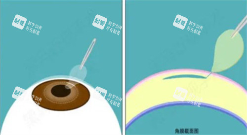 激光近视手术过程图解 激光近视手术过程图解