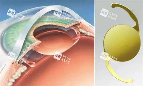 白内障人工晶体的选择