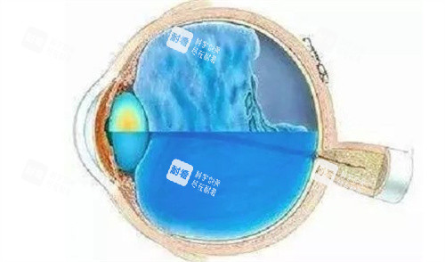 折叠式人工玻璃体球囊