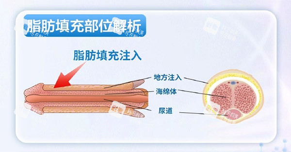脂肪增大增粗照片.jpg