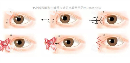 小睑裂手术过程 小睑裂手术过程