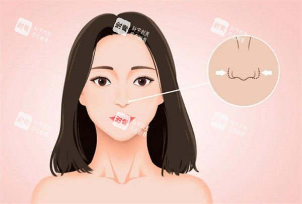 鼻翼缩小手术卡通图 鼻翼缩小手术卡通图