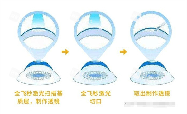 全飞秒激光治眼睛切口 全飞秒激光治眼睛切口