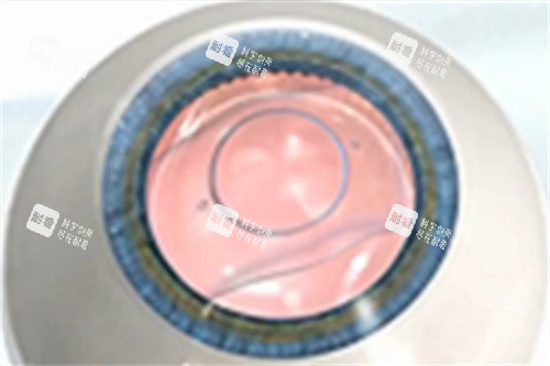 ICL晶体手术完成 ICL晶体手术完成