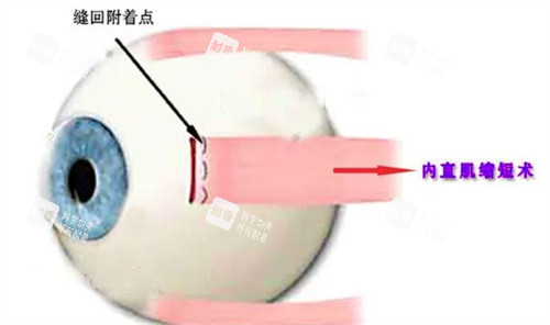 斜视手术 斜视手术