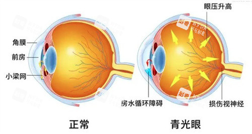 急性闭角型青光眼