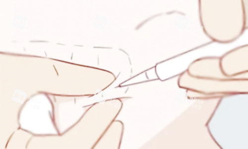 溶脂针