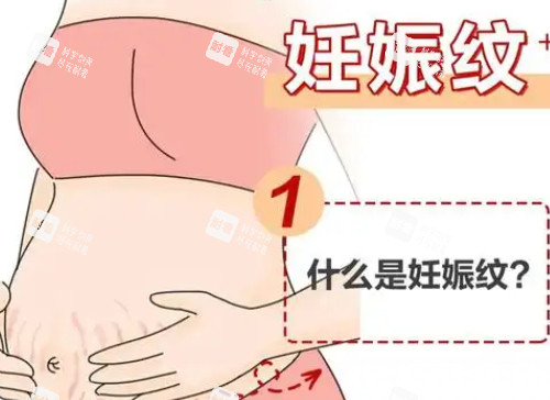什么是妊娠纹漫画图