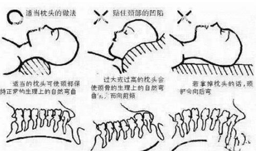 不良的姿势导致富贵包